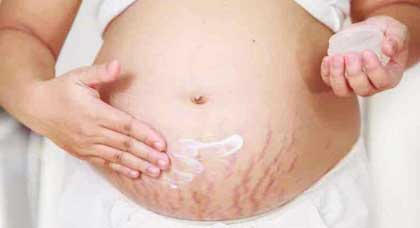 روغن زیتون برای ترک شکم در بارداری